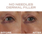 Plump It No Needles Derma Filler Pods Starter Kit 15 x 10ml - Image 4