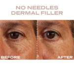 Plump It No Needles Derma Filler Pods Starter Kit 15 x 10ml - Image 5