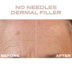 Plump It No Needles Derma Filler Pods Starter Kit 15 x 10ml - Image 8