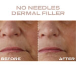 Plump It No Needles Derma Filler Pods Starter Kit 15 x 10ml