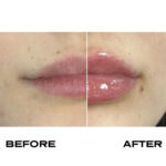 Plump It No Needles Lip Filler Kit Extreme Volume - Image 2
