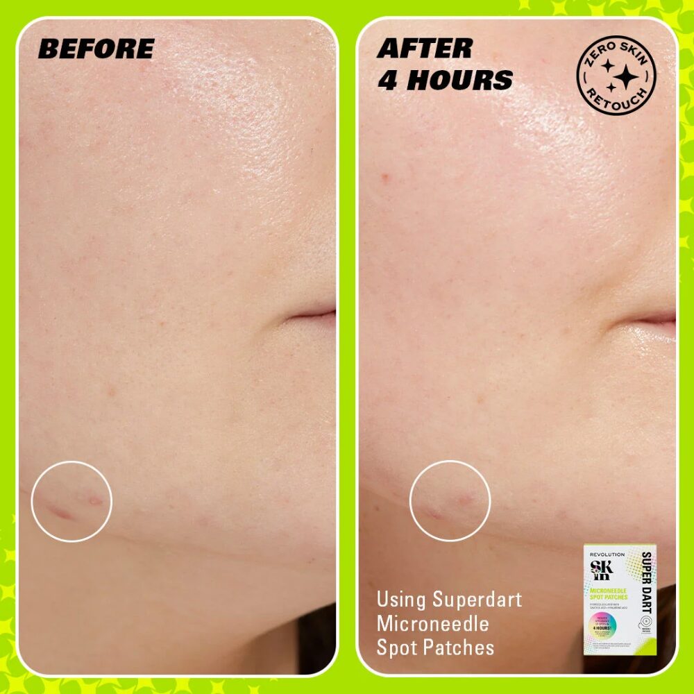 REVS0220-2.jpg Revolution Skincare Super Dart Microneedle Salicylic Acid Hydrocolloid Spot Patches x9 - Image 1