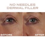 Plump It No Needles Derma Filler Pods Starter Kit 15 x 10ml - Image 6