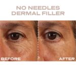 Plump It No Needles Derma Filler Pods Starter Kit 15 x 10ml - Image 7