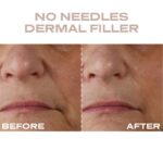 Plump It No Needles Derma Filler Pods Starter Kit 15 x 10ml - Image 10