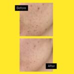 Acnemy Zitpeel 40ml - Image 3